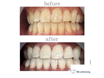 NAホワイトニング 自由が丘店/【before/after】