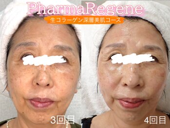 レイネ(REINE)/ファーマリジェネ深層美肌コース