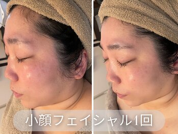 ラシク 吉祥寺(LACHIC)/小顔集中ケア
