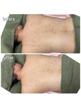 クラリ(Clari)/ボディケア/美肌/黒ずみ/ニキビ