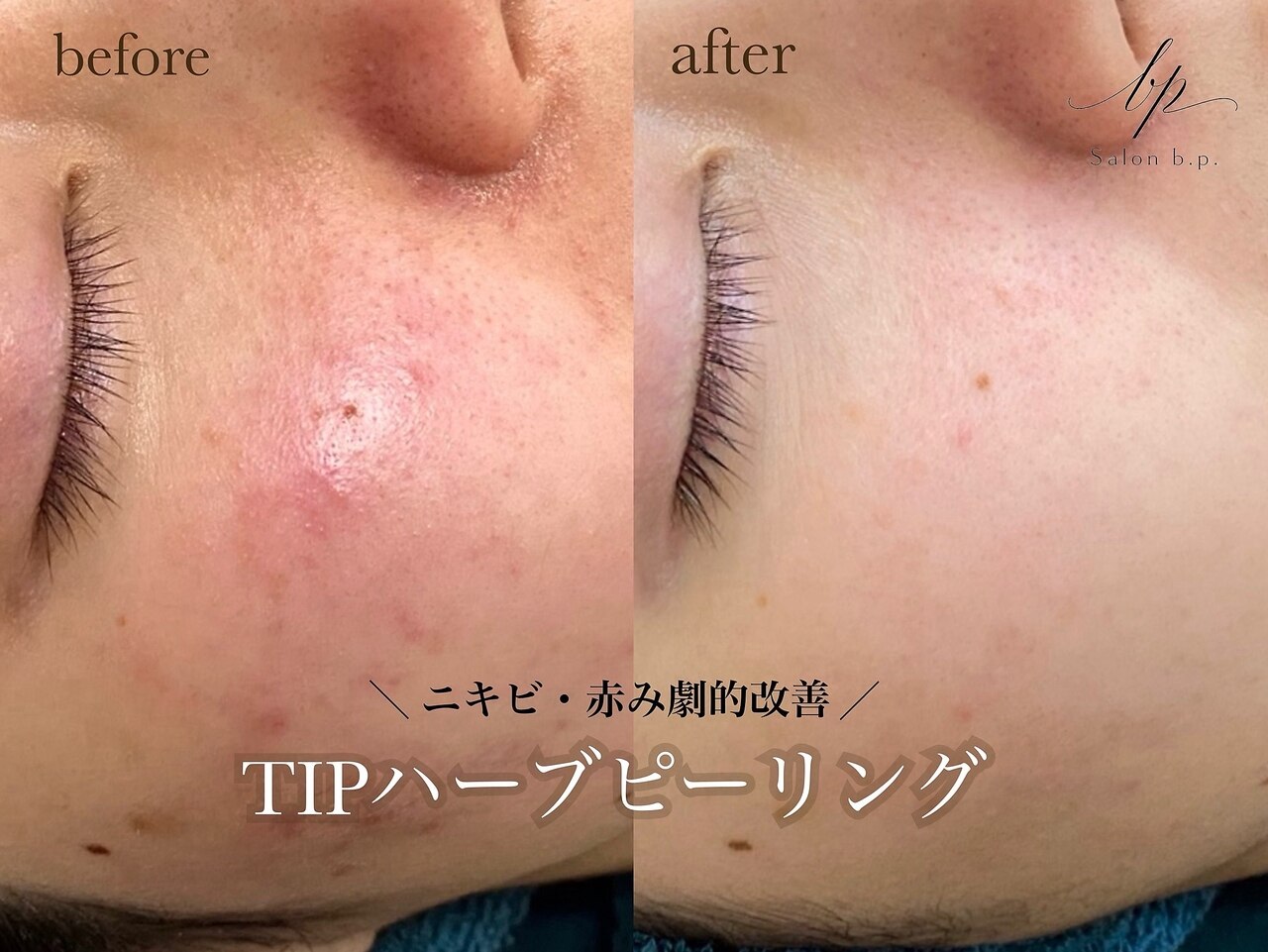 ハーブピーリングbeauty page1 マヤヒメ(mayahime)｜ホットペッパービューティー
