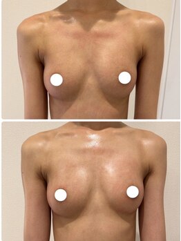 ルフルリール(Refleurir)/◆バストアップ症例/育乳◆