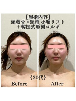 マルウル(maluulu)の写真/「小顔になりたい！」を叶える【頭蓋骨×頸椎 小顔リフト】小顔矯正と美容整体のいいとこどり♪