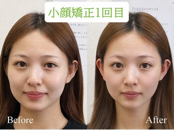 オズ六本木の写真/【小顔矯正専門店だからできる圧巻の施術】下がった輪郭・エラ・むくみ改善！引き上がった映える小顔に♪