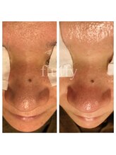 フラフィ 宇都宮本店(fluffy)/オイルクレンジング【毛穴】