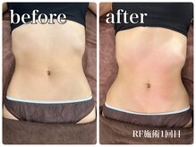 サロンドルクリア(Salon de LUCULIA)/エステ＃ラジオ派脂肪燃焼コース