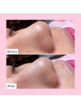 ホワイトラボ 梅田茶屋町(White labo)/【施術例】ハイドロフェイシャル