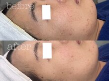 ロイ 初生店(LOI)/ハーブ×プラズマ