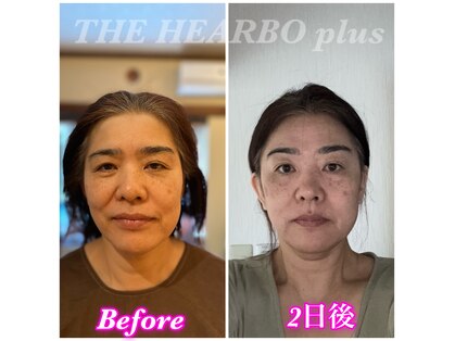 ハーボプラス(THE HEARBO plus)の写真