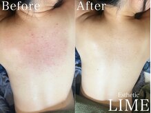 ライム 新越谷(LIME)/ハーブピーリング｜背中ニキビ