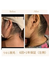 ガムラン(Gamelan)/うなじ脱毛　6回＋1年保証　