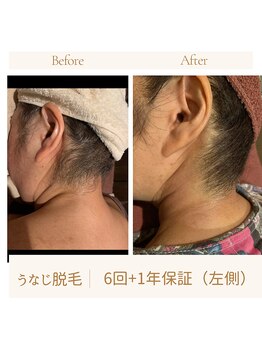 ガムラン(Gamelan)/うなじ脱毛　6回＋1年保証　