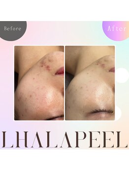 バブルビューティー(Bubble beauty)/ララピール・LDM・LED1回施術後