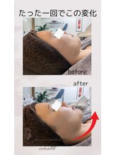 フェイシャルサロン セレスタイト/一度で変化！顎下の奇跡