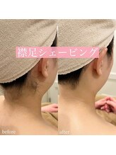 リンド エステ まつげ 京成大久保(Lind)/襟足シェービング