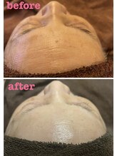 雅菜(miyabina)/おでこのデキモノなくなりました