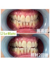 ルブラン 奈良店(Le Blanc)/長年悩みの黄ばみ
