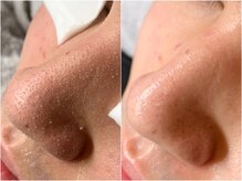 ルイス(LOUIS)の雰囲気（当店看板メニュー【毛穴レス肌管理】皮脂&黒ずみ&ざらつき改善！）