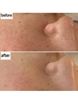 メナードフェイシャルサロン 岐阜茜部/クリーンパック