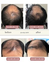 スカルプラボ(Scalp Lab)/moumitu症例8ヶ月