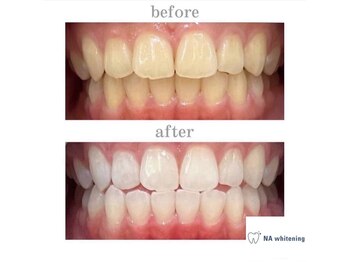 NAホワイトニング 自由が丘店/【before/after】