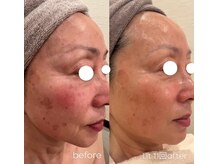 ランポ(lampo)の雰囲気（大人気メニュー！《幹細胞Lit》◯Lit 11回目）