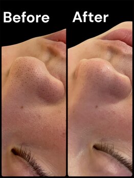 ブライトプラス(BRIGHT+)/ハイドロフェイシャル毛穴洗浄