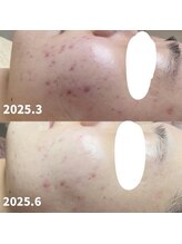 サロンビューティー美優/毛穴洗浄毛穴の黒ずみ・いちご鼻