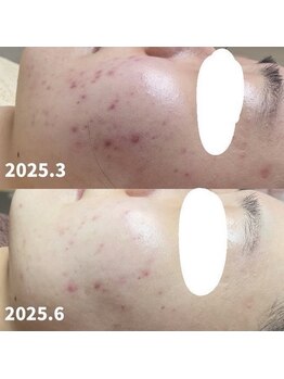 サロンビューティー美優/毛穴洗浄毛穴の黒ずみ・いちご鼻