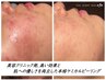 【毛穴ニキビ 都度】毛穴吸引×透光ピール×高濃度ビタミンC導入14300→11000