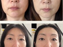 たるみアガル(たるみagaru)/たるみ引き上げ×透明感アップ