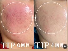 ビーピー 渋谷(b.p.)/ハーブピーリング肌質改善