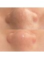 毛穴ケアサロン そらな&nbsp;小さい毛穴汚れでも「お鼻がツルツル」と喜んでくださいました♪