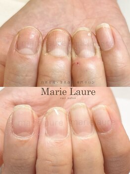 マリーロール 淀屋橋本店(Marie Laure)/自爪育成/深爪矯正/ネイルケア