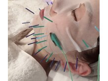 瑞 鍼灸院/幹細胞パック美容鍼