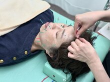 ころも接骨院 豊田本院の雰囲気（美容鍼でお顔のリフトアップ♪）
