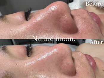ナチュールムーン(Nature moon.)/毛穴洗浄