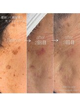 キレイシェア バイ プリンセスローズ静岡駅店(KIREI SHARE)/シミ、ニキビの気になる方