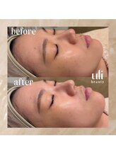 ウリ(uli beauty)/比較写真