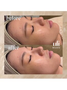 ウリ(uli beauty)/比較写真