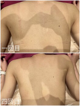 グレイスボディ BiViつくば店(Grace Body)の写真/背中・うなじ脱毛で後ろ姿美人！脱毛機ランキング3部門1位の感動をあなたに♪