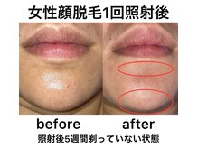 ケーナインエッセ(K9 esse)/美肌顔フル脱毛