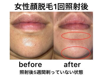 ケーナインエッセ(K9 esse)/美肌顔フル脱毛