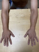 プライマル(PRIMAL)/男性腕脱毛の施術事例