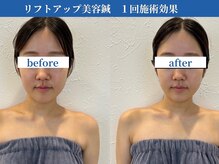 ラ カルナベル(La Carnabel)/美容鍼/耳つぼジュエリー/小顔