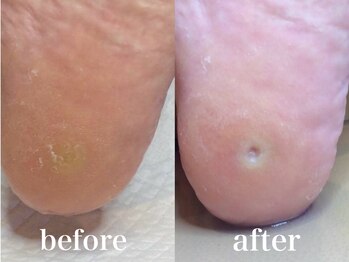 ドクターネイル爪革命 札幌本店/症例紹介15 たこ・うおのめ