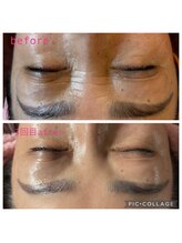 リリアン(Re Lien)/☆ララピールbefore・after☆