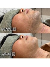 ボウイズ 磐田店(BOYZ)/ヒゲ脱毛　3回　before after