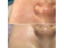 エステティックサロン Sの雰囲気（NMNピーリング月1回トリートメントでここまで変わります！1年後）