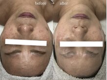 サロン レナ(Salon Re:na)/Revi ハーブピーリング